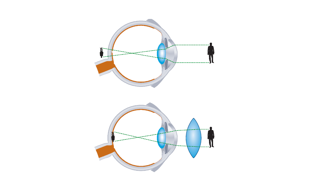 2 látomás 100-ból látás legújabb kezelések